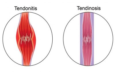 Tendinosis Versus Tendinitis