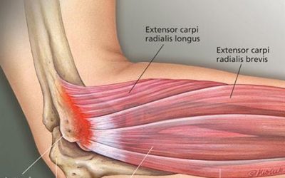 Tennis Elbow