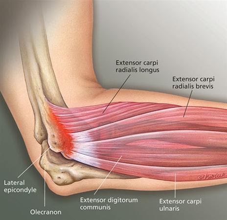 Tennis Elbow